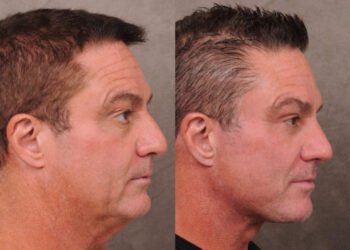 WSJ: Айтишники Кремниевой долины делают подтяжки, чтобы не потерять работу из-за возраста